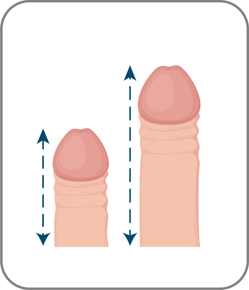 Penis enlargement surgery turkey