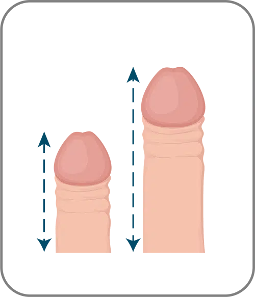 Penis enlargement surgery turkey