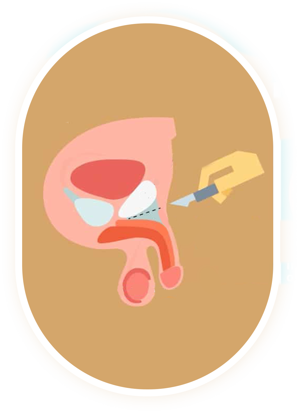 Penis Lengthening Surgery