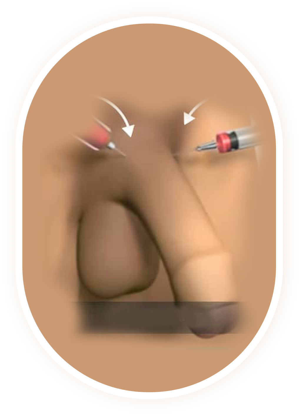 Fat Transfer Penis Enlargement